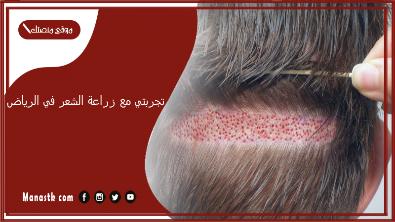 تجربتي مع زراعة الشعر في الرياض